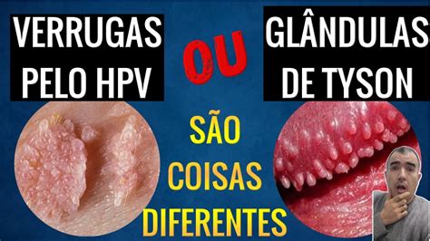 Glândulas de Tyson: o que são e veja se é preciso tratá